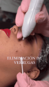 🎁Lápiz Cauterizador DermaClear USB Quita Verrugas Y Lunares 🎁